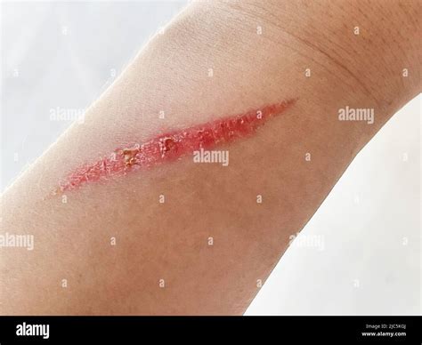 Scar Over Wound at Alma Jones blog