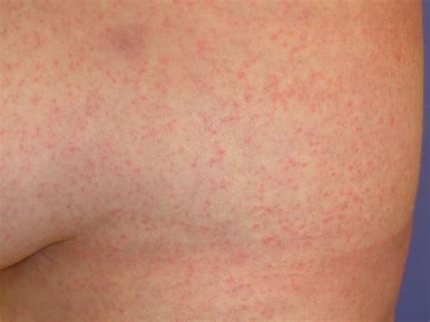 Viral Rash: 9 Types, Causes, Symptoms, and Treatment