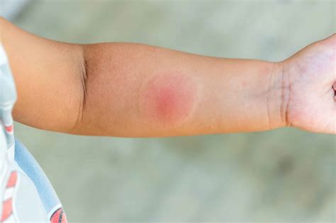 Australian Spider Bite Symptoms, Signs, and First Aid | STC