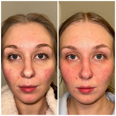 10 days post Excel V laser : r/Rosacea