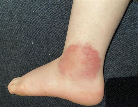 Can Yellow Jacket Stings Cause Cellulitis at Henry Christie blog