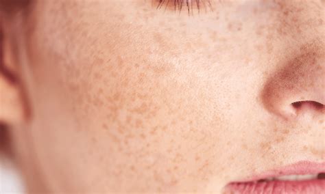 Mole vs Freckle: The Difference Between These Skin Spots | Software