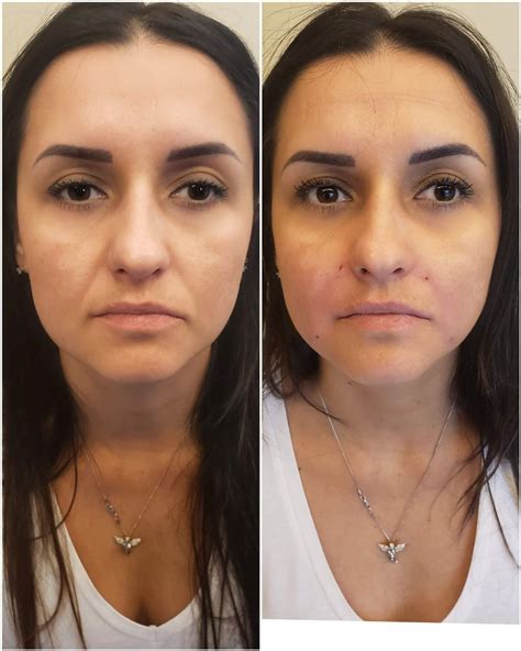 Nasolabial fold filler - Doctor Led Aesthetic Clinic - London Beauty Clinic