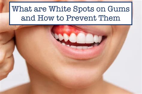 White Spots On Gums Clinical Condition Of Patient's Oral Cavity, White