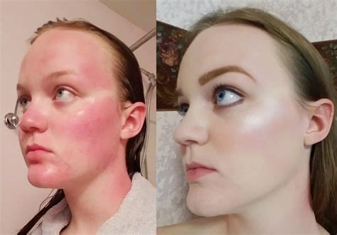 Face Rash Looks Like Sunburn at Gayle Poston blog
