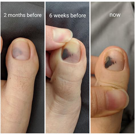 Top 101+ Pictures Pictures Of Black Spot Under Toenail Superb