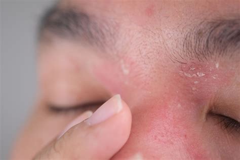 Rosto De Psoriase Psoríase Dra. Rafeala Salvato