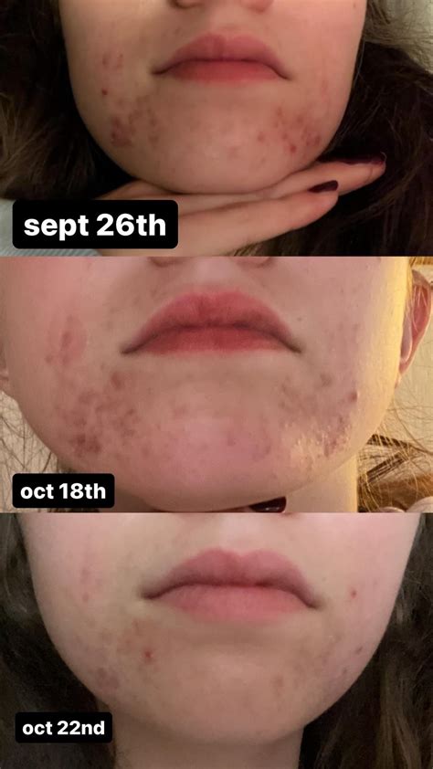 de la cruz sulfur before and after! : r/Perioral_Dermatitis_