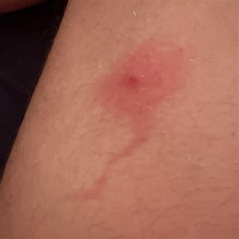Pimple with red patch : r/pimplecommunity