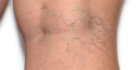 What Causes Spider Veins? | Lexington Vein Institute