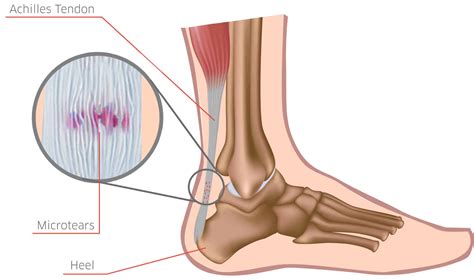 Spotting Achilles Tendinitis: Here are the Warning Signs