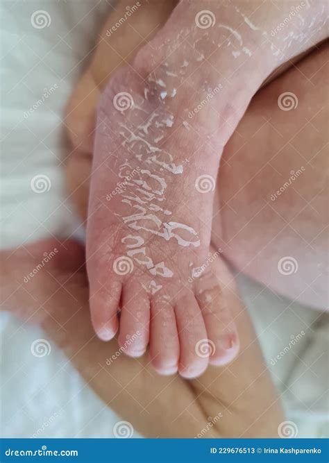 Newborn Baby Feet with Flaky Dry Skin. Infant after Born with Very Dry, Wrinkled, Cracked Skin ...