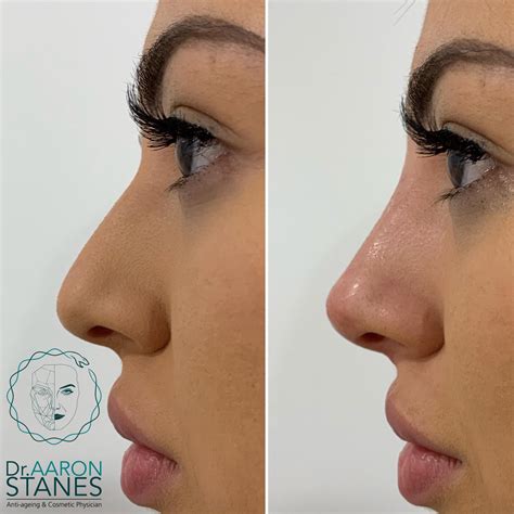 Non surgical rhinoplasty melbourne reshaping your dream nose – Artofit
