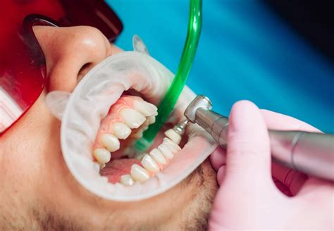 What Are the Pros and Cons of Deep Cleaning Teeth?