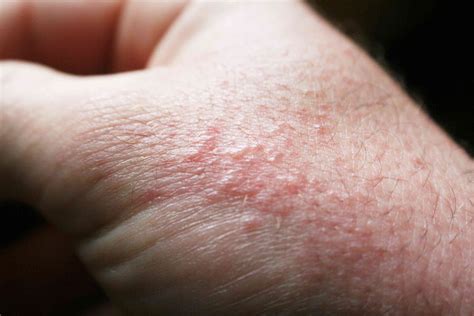 Causes Of Itchy Skin Urgent Care For Rash Treatment Near Me In