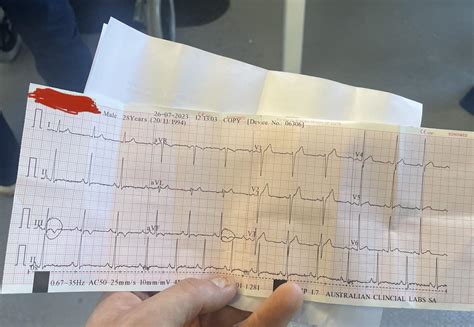 Heart Attack Ecg