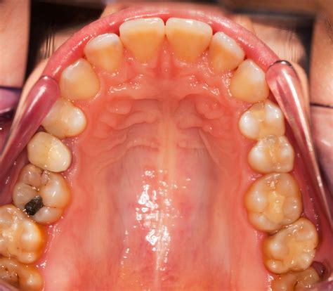Cold Sore Inside Cheek
