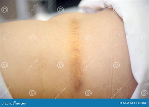 A Scar of Appendicitis on the Abdomen of a Woman Stock Image - Image of removal, medical: 175594953
