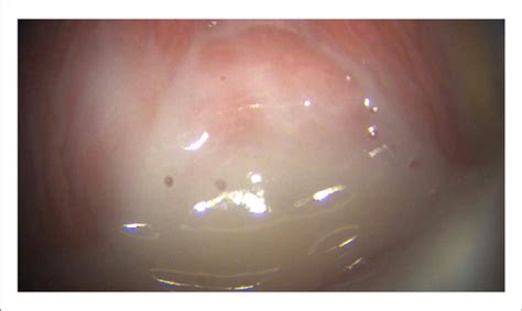 What Does BV Discharge Look Like Pictures? | Conceive Plus®