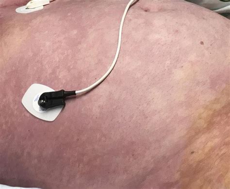 Waterhouse Friderichsen Syndrome