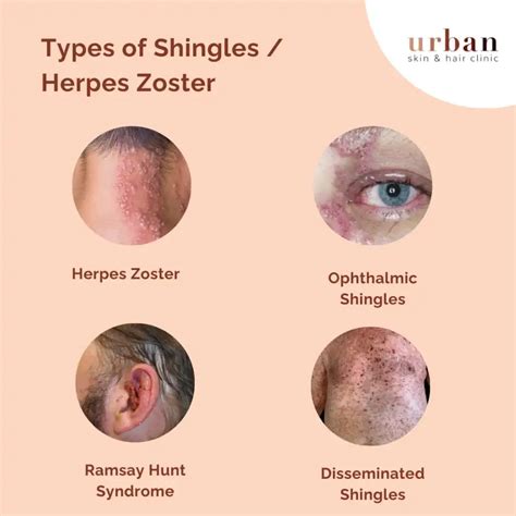 Herpes Zoster Types, Causes & Symptoms