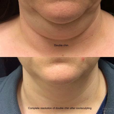 CoolSculpting vs. Sono Bello - Which One is Better? VIVAA