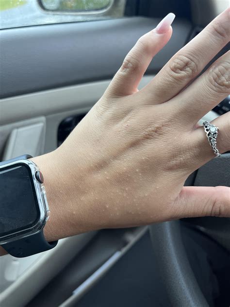 Small itchy skin-colored bumps on the back of my hands : r/DermatologyQuestions