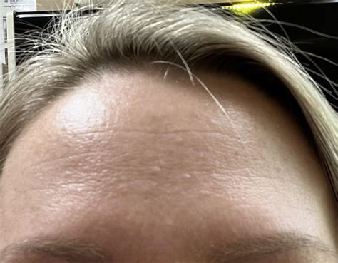 Help! What are these bumps on my forehead? I got them when I was pregnant 7 years ago and they ...