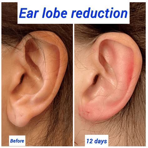 Earlobe Reduction Surgery | Ear Surgery - Harley Clinic