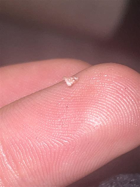 TW: Gross Teeth What is this on the inside of my left Cheek in my mouth ...