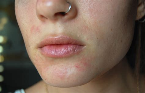 Perioral Dermatitis Chin