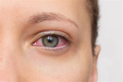 Eye Allergies vs Pink Eye: Symptoms & Solutions