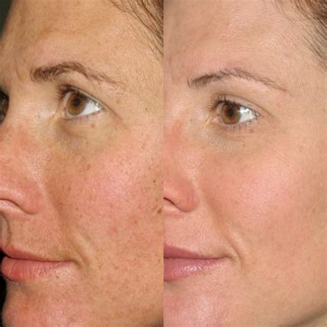 IPL (BBL) Laser Skin Treatment — Tahoe Injectables + Aesthetics Medical Spa