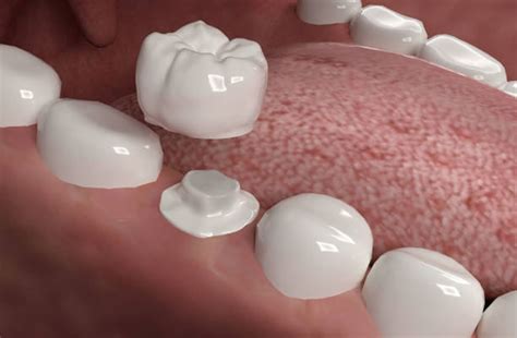 The differences and similarities between men's and women’s teeth | Dental Concepts