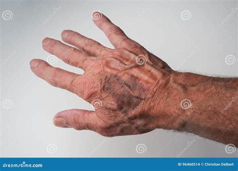 Blood Spots On Arms Causes at Jennifer Wilkins blog