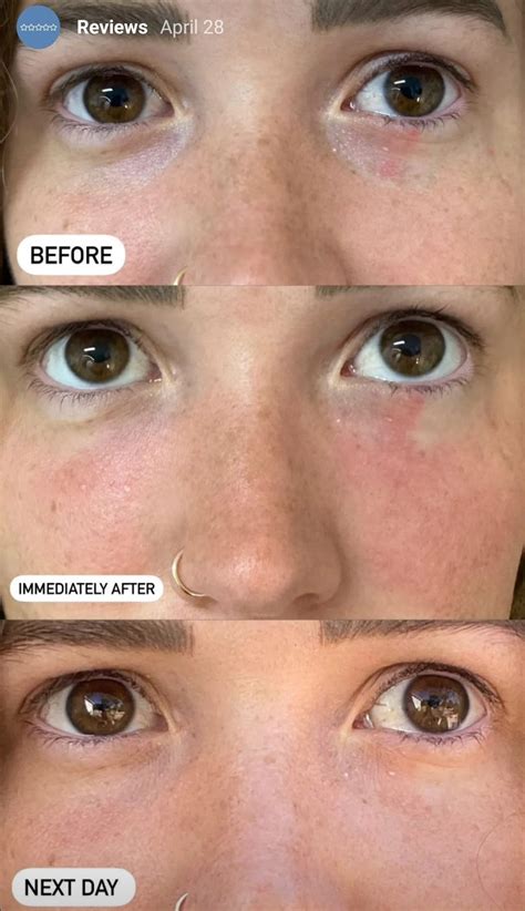 PRF / PRP for Under Eyes — Wild & Beautiful Med Spa