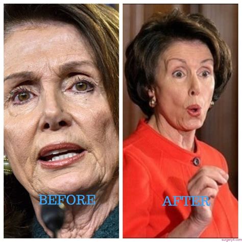 Donny Osmond Plastic Surgery Photos [Before & After] - Surgery4