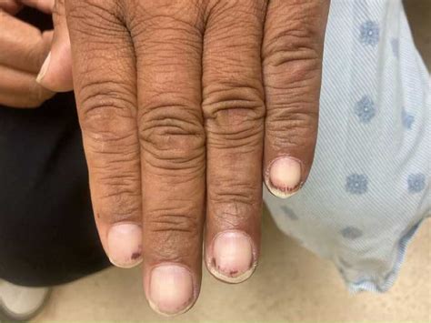 Splinter Hemorrhage Endocarditis Cardiac Trials On X: "5/ Splinter