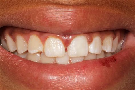 Broken Front Tooth Dental Emergency | NYC Dentist