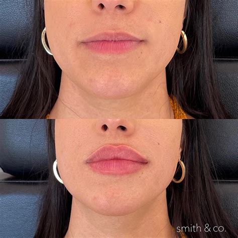 kysse + ashton — Miami Beach Botox Specialist | Botox lips, Beauty ...