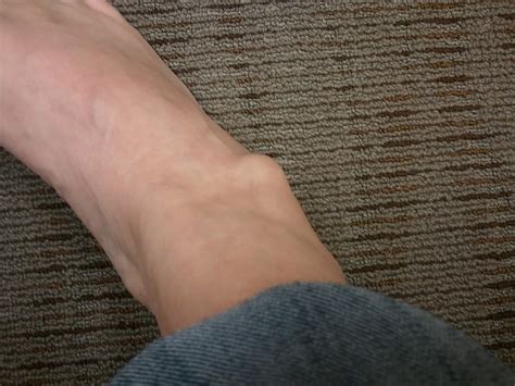 Why Do You Have Lump on Your Ankle? | New Health Advisor