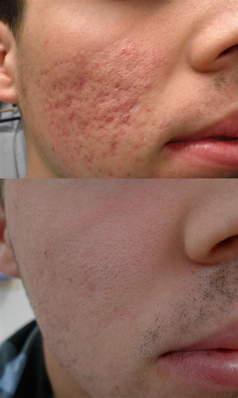 How Long Does Laser Acne Scar Removal Take at Susanne Lumpkin blog