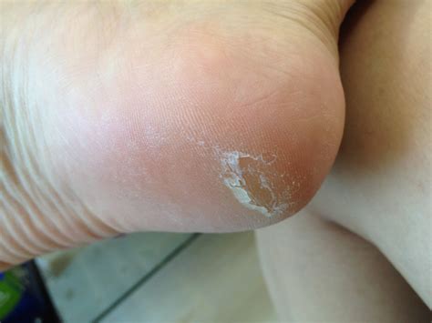 Why Are My Feet Peeling In Circles at Oralia Raby blog