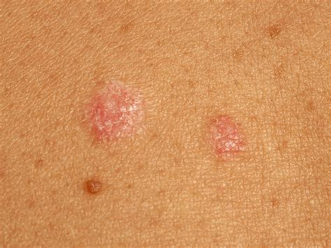 Pityriasis lichenoides chronica et acuta
