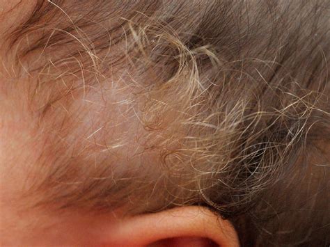 Vellus Hair Nevus at Joanne Tindall blog