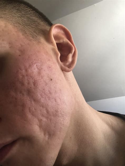 Cystic Acne Scars