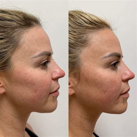 Pdo Threads Before And After Nose at Kathleen States blog