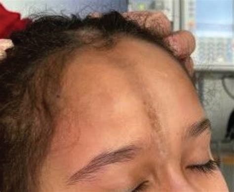 Linear Scleroderma Forehead
