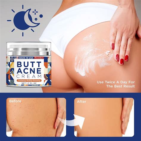 Buy Butt Acne Clearing Cream, Thigh Acne Clearing treatment, Made in USA, Clears Acne, Pimples ...