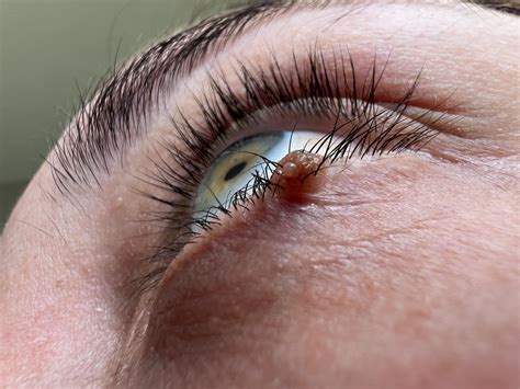 Mole Removal - Lower Eyelid : r/PlasticSurgery